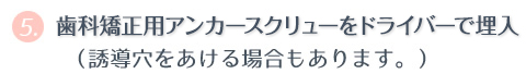 ⑤ 歯科矯正用アンカースクリューをドライバーで埋入。（誘導穴をあける場合もあります。）