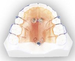 装置の種類（クリアブラケット、リンガル、マウスピースの装置説明） 